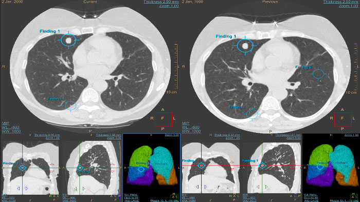 CT Lung Nodule Assessment (LNA)
