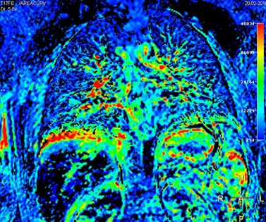 Рис. 3А. Цветная карта перфузии легких, полученная при свободном дыхании пациента