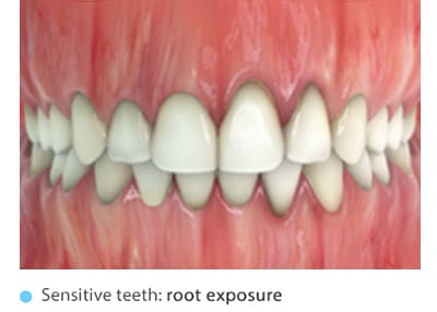 Чувствительность зубов: обнажение шейки зуба 
