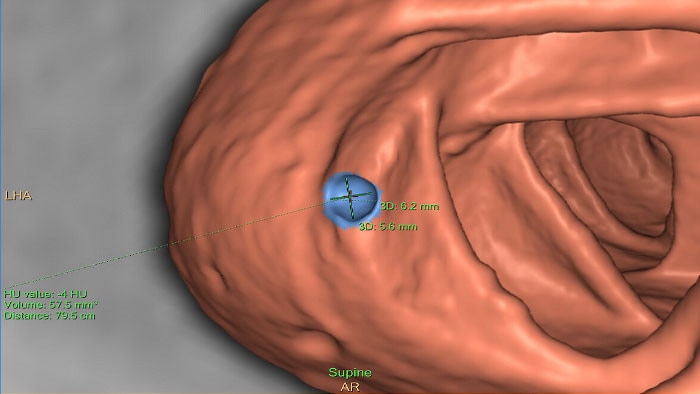 CT Virtual Colonoscopy