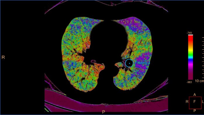 CT Pulmonary Artery Analysis