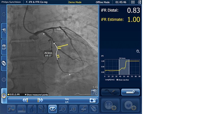 совмещение данных iFR, длина правой коронарной артерии