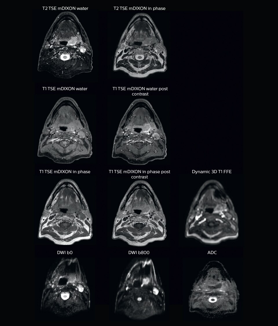 МРТ головы и шеи для планирования лучевой терапии