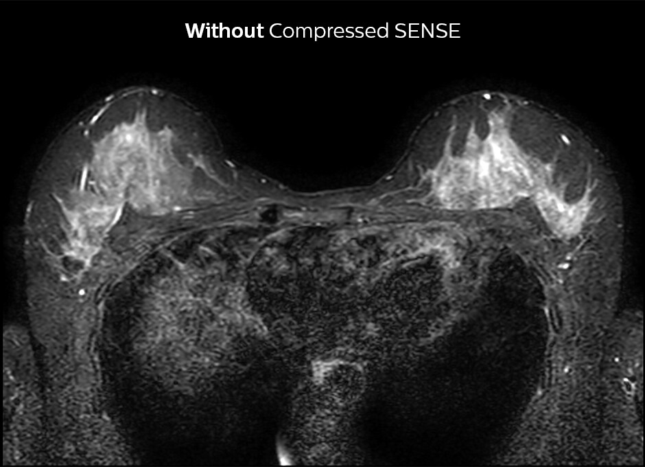  D РАЗМЕШАТЬ грудь БЕЗ сжатого изображения SENSE