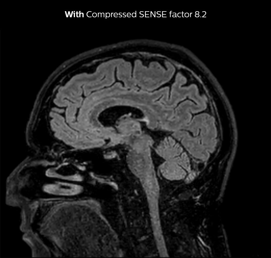  D FLAIR brain Сжатое изображение фактора SENSE