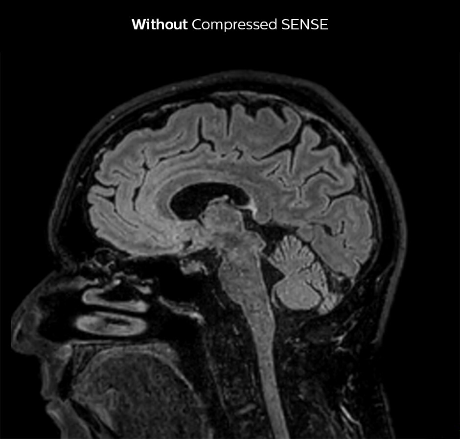  D FLAIR brain БЕЗ сжатого изображения SENSE