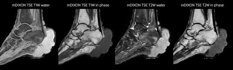 МРТ голеностопного сустава с применением последовательности mDIXON TSE