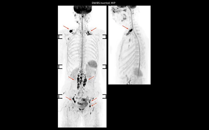 Диффузионно-взвешенная визуализация всего тела пациента с лимфомой при помощи системы Prodiva, больница Seirei Mikatahara