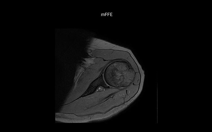 МРТ плечевого сустава в высоком качестве, технология mFFE