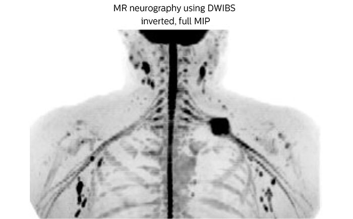 МР-нейрография с использованием метода DWIBS, инвертированные изображения, проекция максимальной интенсивности.