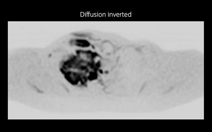 МРТ опухоли Панкоста с применением метода дифузионно-взвешенной визуализации, выполненная при помощи системы Prodiva, больница Seirei Mikatahara