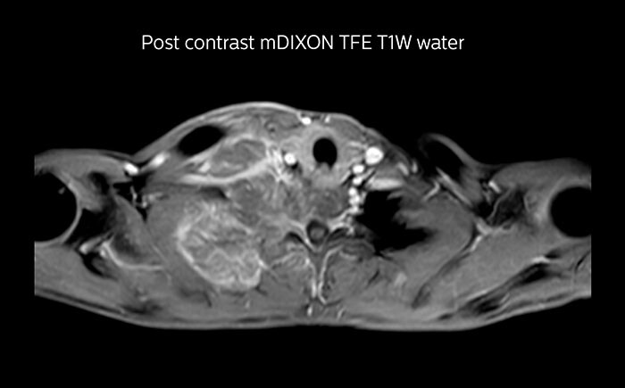 МРТ опухоли Панкоста с применением метода mDixon, выполненная при помощи системы Prodiva, больница Seirei Mikatahara