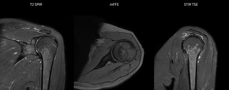 МРТ плечевого сустава в высоком качестве с большой площадью охвата