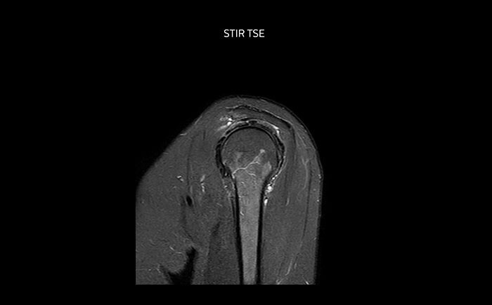 МРТ плечевого сустава в высоком качестве, технология STIR, импульсная последовательность TSE