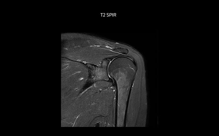 МРТ плечевого сустава в высоком качестве, с применением последовательности T2 SPIR
