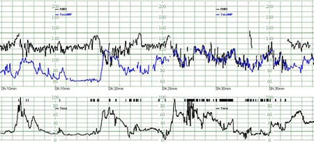 Philips fetal monitoring EUR paper speed