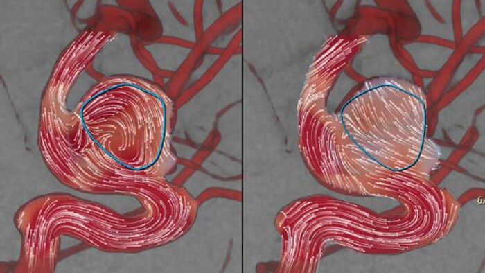 Aneurysmflow image