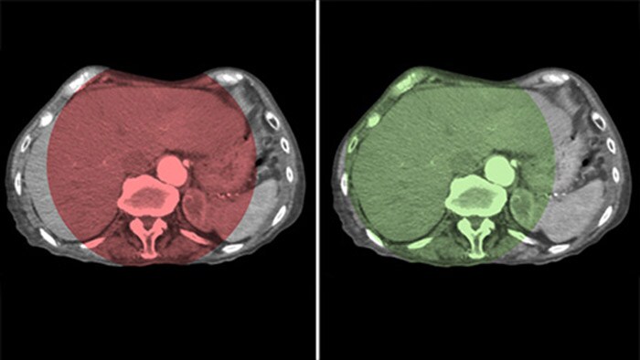 Полный охват печени с технологией CBCT Open