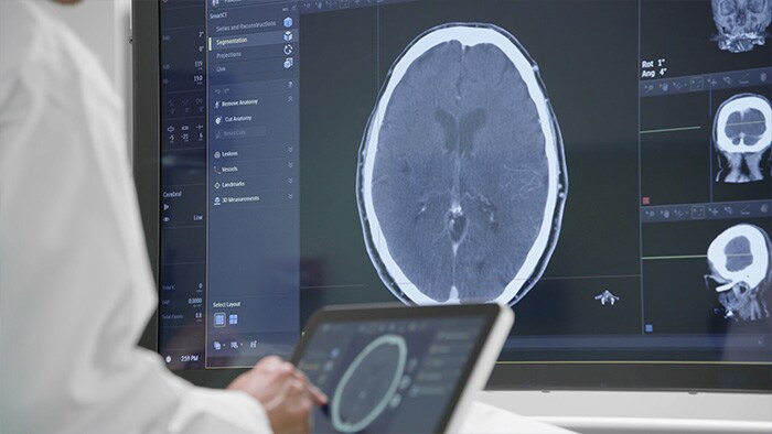 Лечение ишемического инсульта