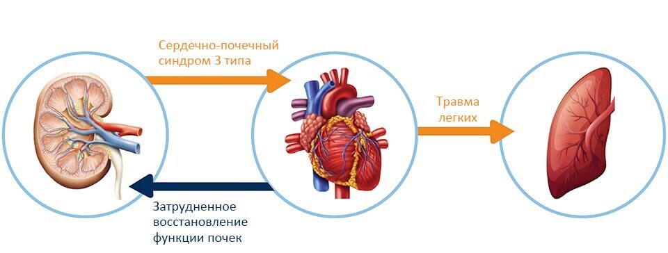 Type 3 cardiorenal syndrome infographic (download .jpg)