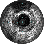 Цифровой полутоновый снимок бляшки EEP с кальцием