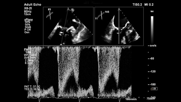 EPIQ CVx — xPlane Doppler