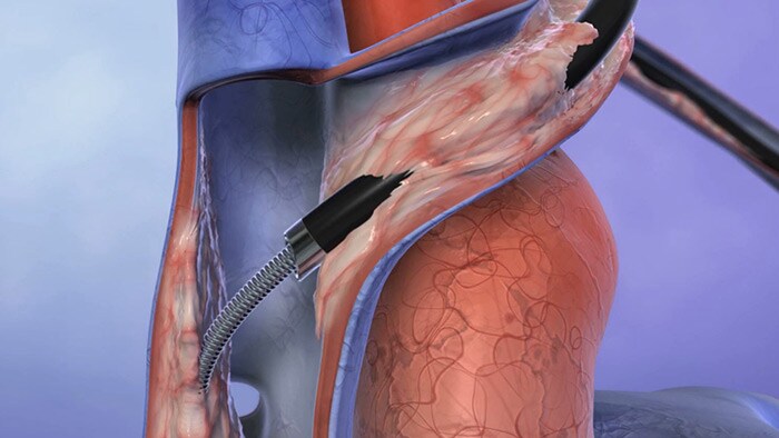 Laser lead extraction animation video