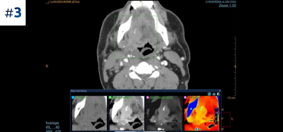 Исследование опухоли в области шеи при помощи современных компьютерных томографов