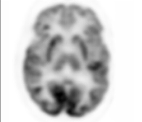 Аналоговое ПЭТ-изображение головного мозга