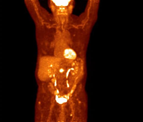 Аналоговое ПЭТ-изображение грудной клетки