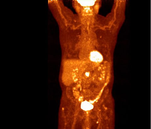 Цифровое ПЭТ-изображение грудной клетки с системы Vereos