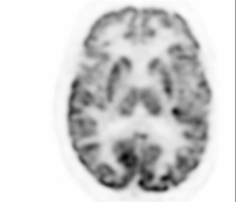 Цифровое ПЭТ-изображение головного мозга с системы Vereos
