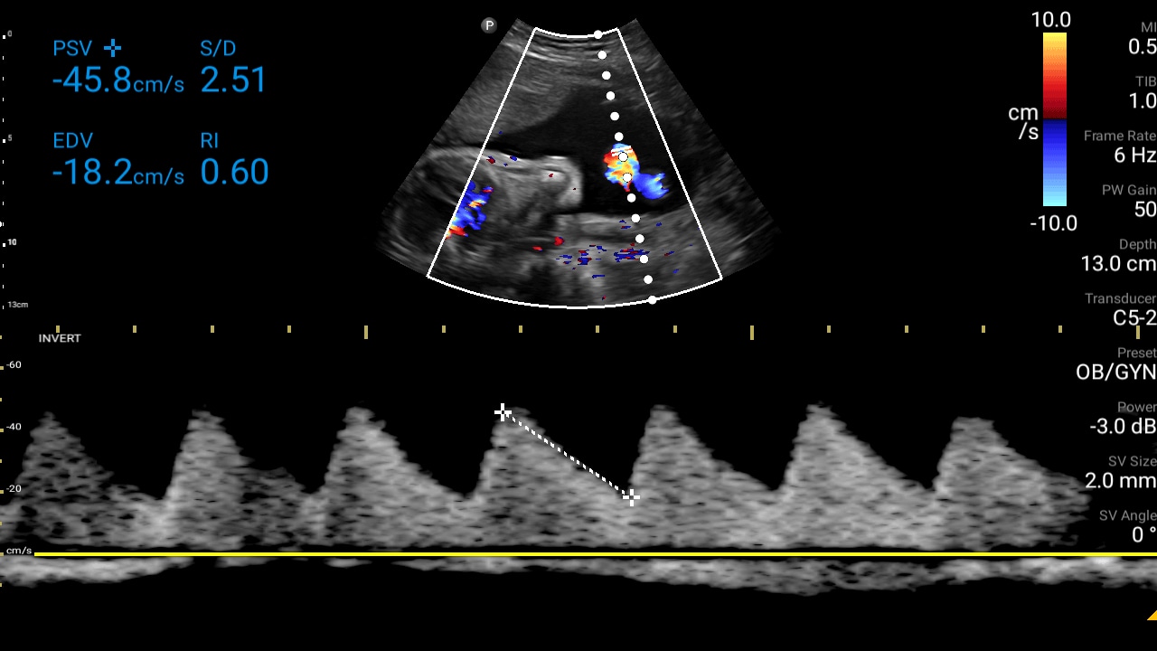 Soft tissue thumbnail second third