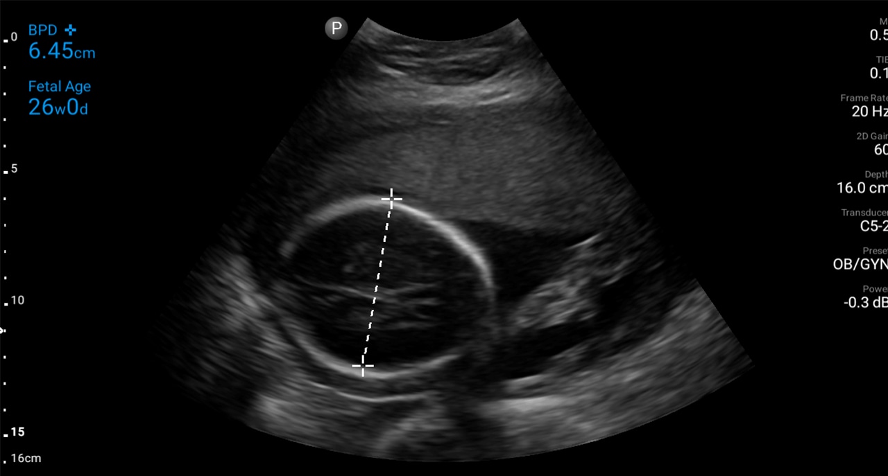 Soft tissue thumbnail second