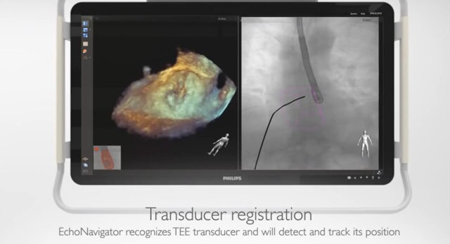 A new dimension in interventional imaging combines live X-ray and 3D ultrasound