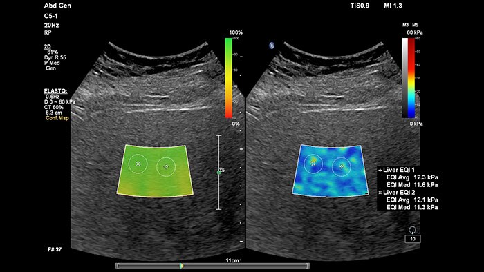 liver imaging