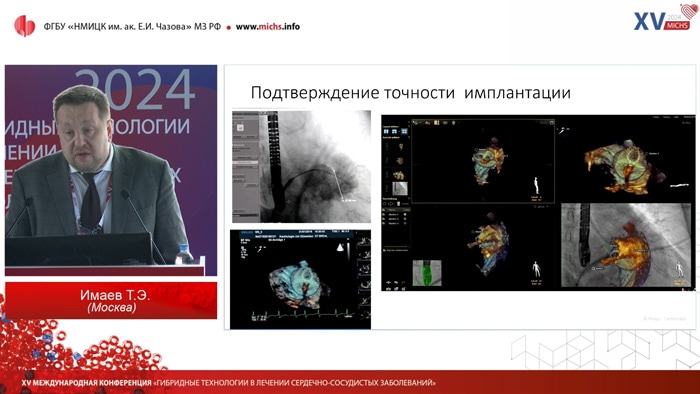 Визуализация при эндоваскулярном лечении структурных заболеваний сердца и патологии аорты