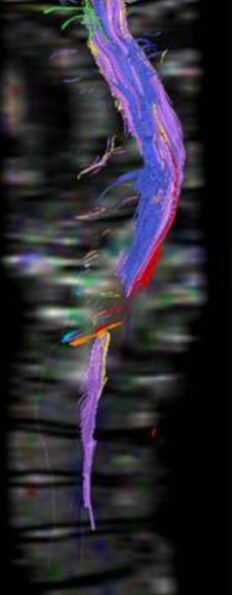 DTI image