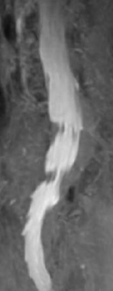 Left_kyphoscoliosis image