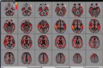 МРТ-исследование-функциональной-активности-мозга