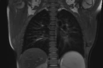 МРТ-визуализация-травматических-повреждений-легких