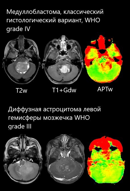 Comparison of scans between 8-year-old and 12-year-old children