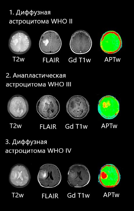 An example of APT to assess the malignancy of tumors