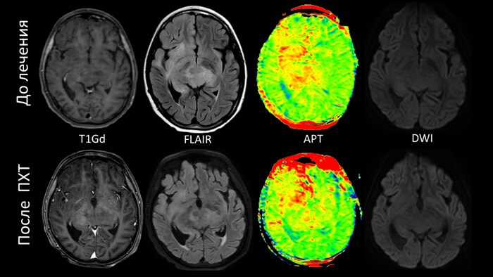 APT-maps visualizing a decrease in the signal only from the thalamus