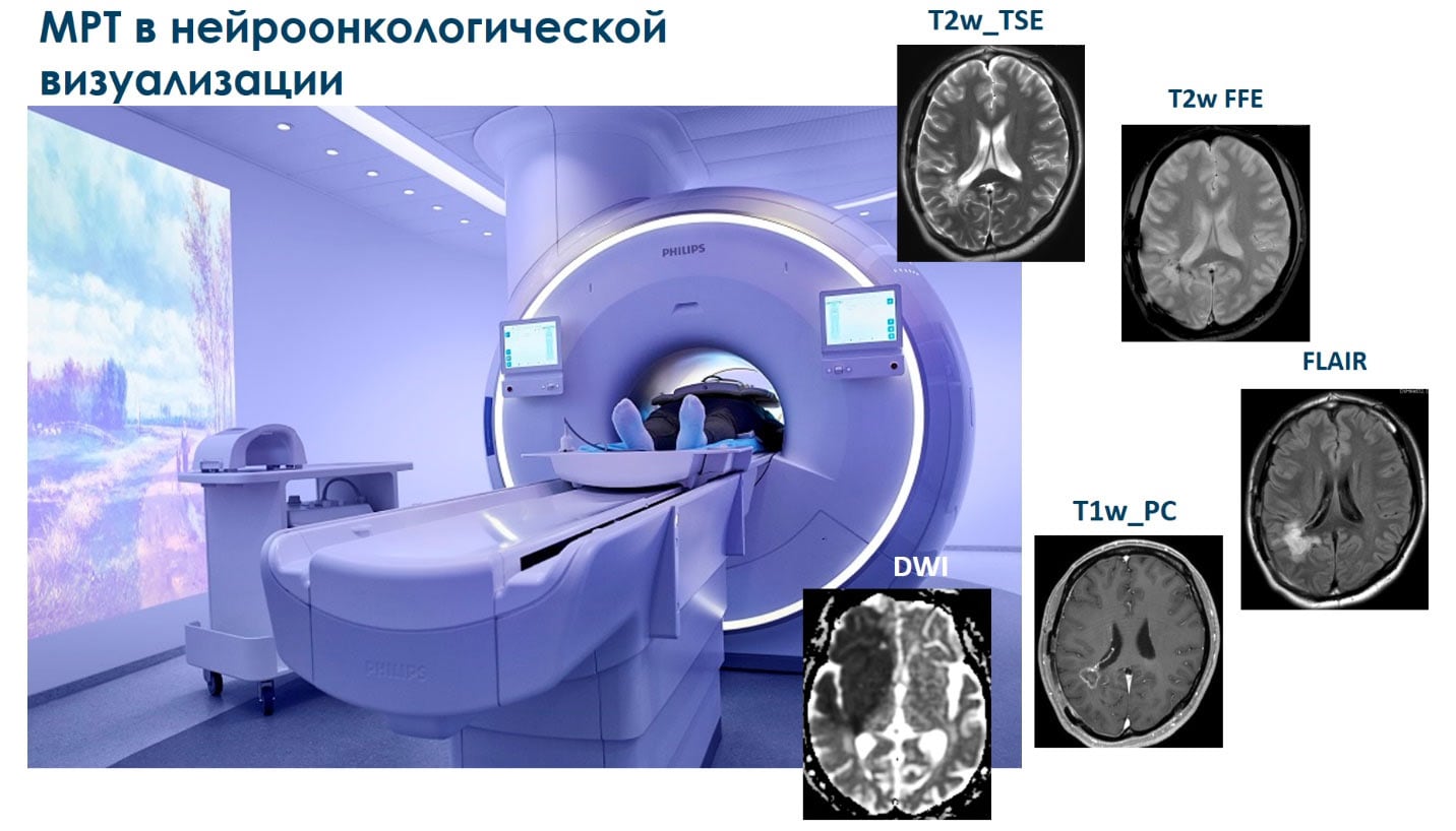 Figure showing common MRI techniques in neuro-oncological imaging