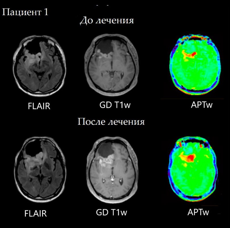 Scan of patient with anaplastic astrocytoma in the right frontal lobe