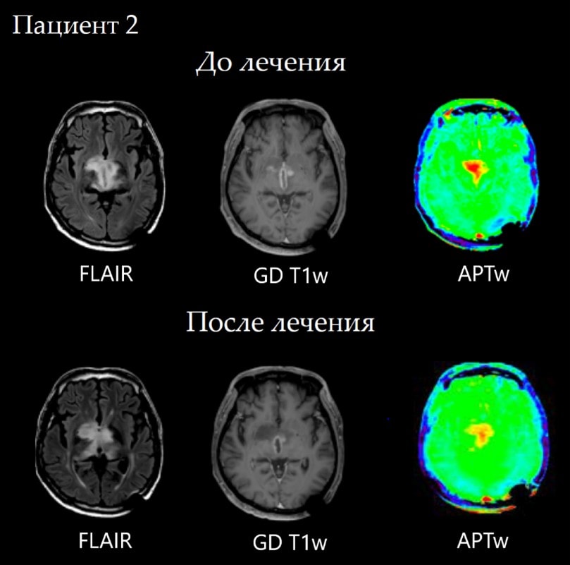 Scan of patient with bitalamic glioblastoma - on the follow-up MRI study after the treatment