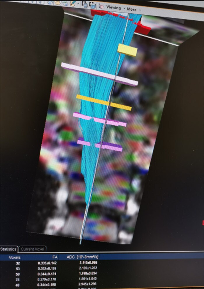 spinal_cord_flexure_zone image