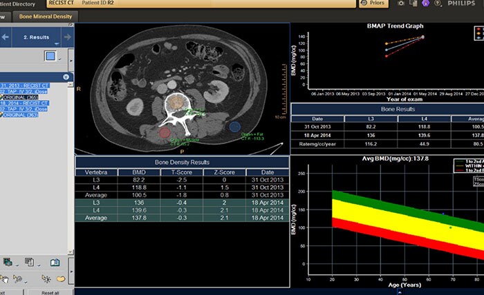 CT Bone Mineral Analysis (BMA) 