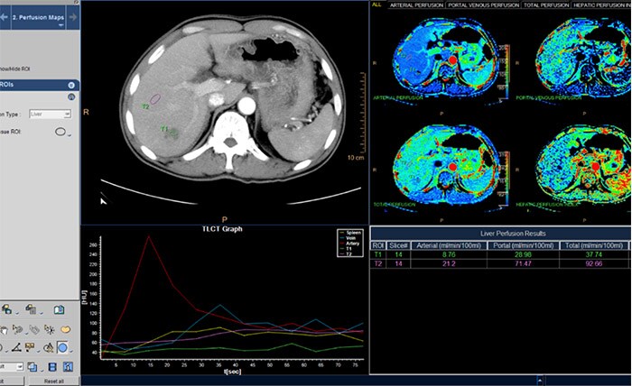 CT Body Perfusion